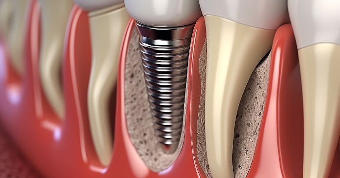 The Benefits of Buying Implant Analogs - 32Dentalab