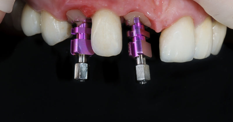 Comparative Analysis: Titanium Grade 5 Abutment Screws vs. Titanium Grade 4 Abutment Screws